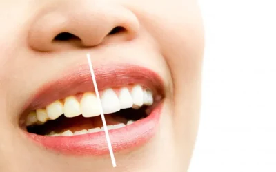 Clareamento dentário: qual a diferença entre o caseiro e o feito no consultório?