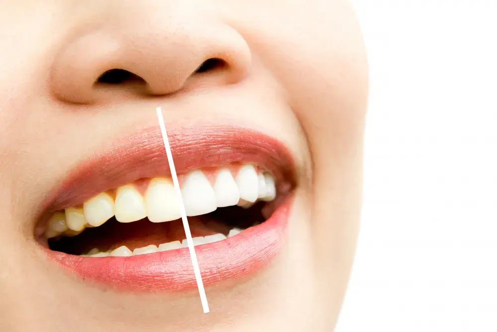 Clareamento dentário: qual a diferença entre o caseiro e o feito no consultório?