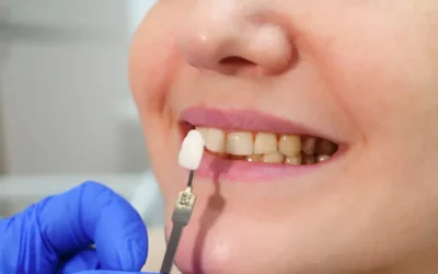 Lentes de contato odontológicas: quem pode fazer e quais os benefícios estéticos