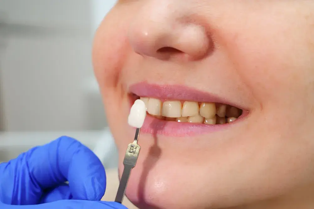 Lentes de contato odontológicas: quem pode fazer e quais os benefícios estéticos