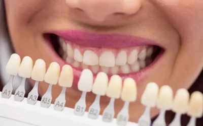 Facetas estéticas: qual a diferença para lentes de contato dental?