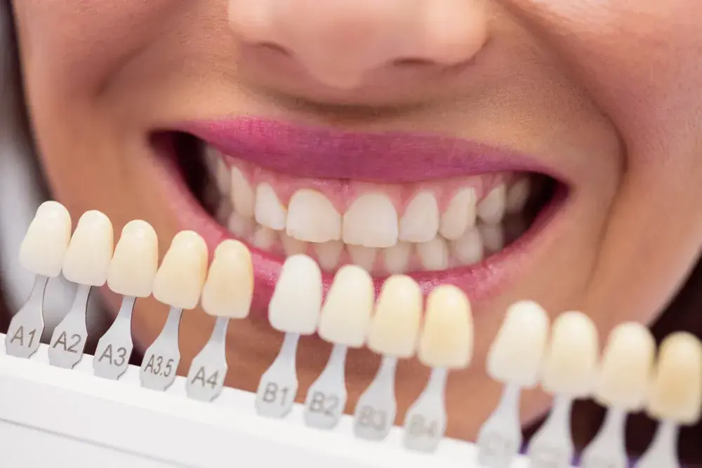 Facetas estéticas: qual a diferença para lentes de contato dental?