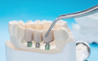Prótese protocolo: solução fixa para quem perdeu todos os dentes