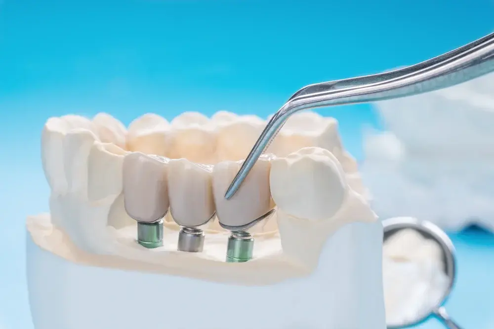 Prótese protocolo: solução fixa para quem perdeu todos os dentes